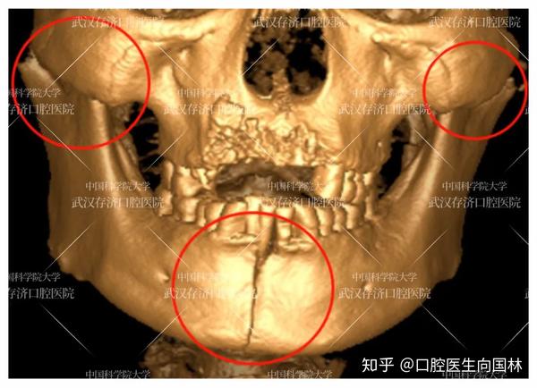 患者双侧髁突粉碎性骨折,下颌骨体部正中骨折,上颌牙槽突骨折伴牙齿