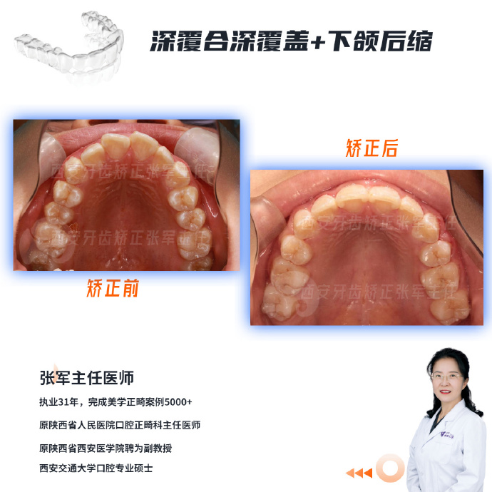 西安牙齿矫正丨嘴突,下颌后缩正畸案例