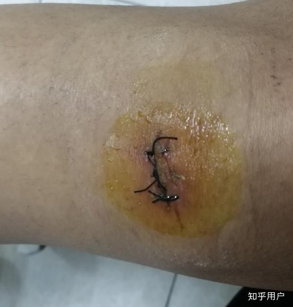 缝针和拆线可怕吗?疼吗?你们当时怕吗?