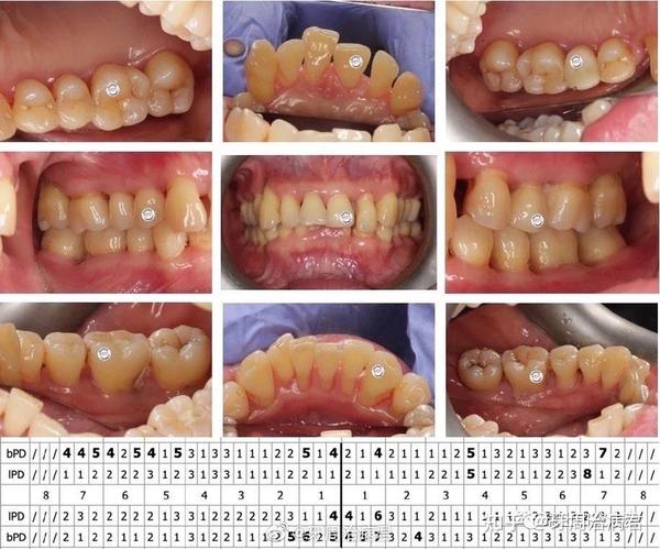 重度牙周炎的多学科治疗