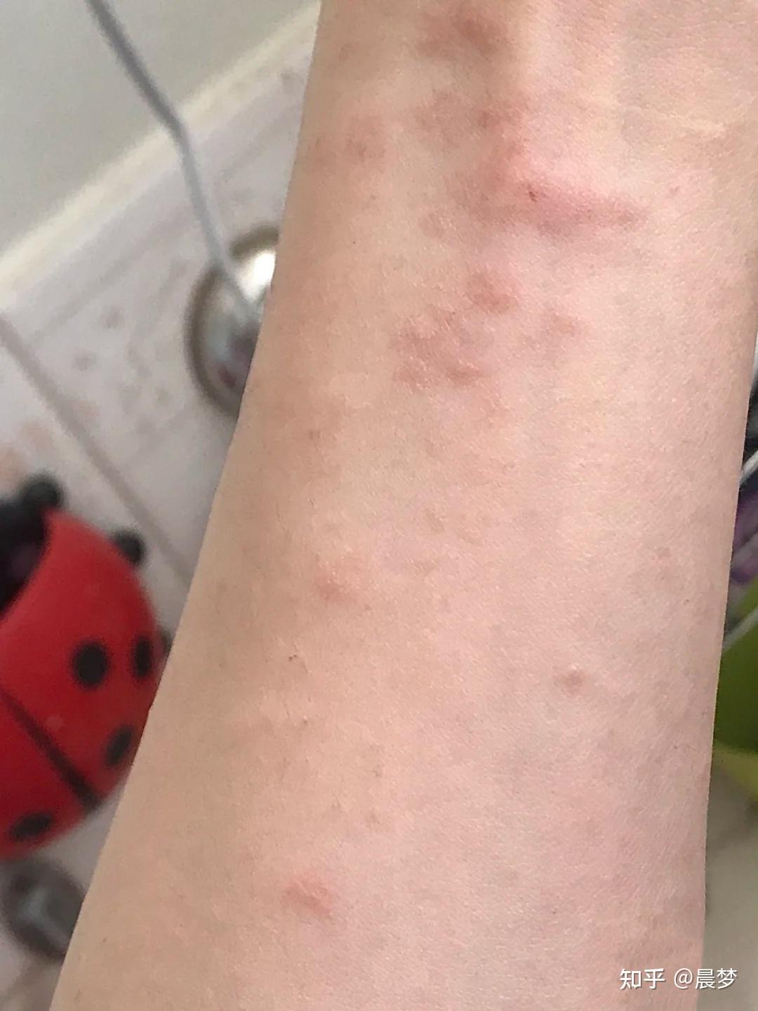 成人慢性湿疹日常应对有什么好的经验吗