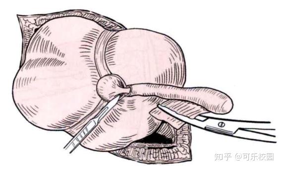 图13 盲肠浆肌层和粘膜间分离