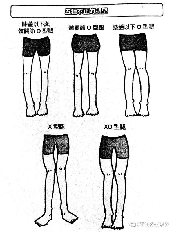 不正腿型有五种,你是哪一种?