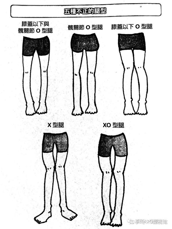 不正腿型有五种你是哪一种