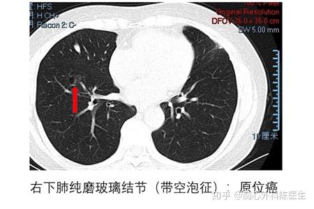 什么是肺结节/肺磨玻璃结节/肺毛玻璃结节?