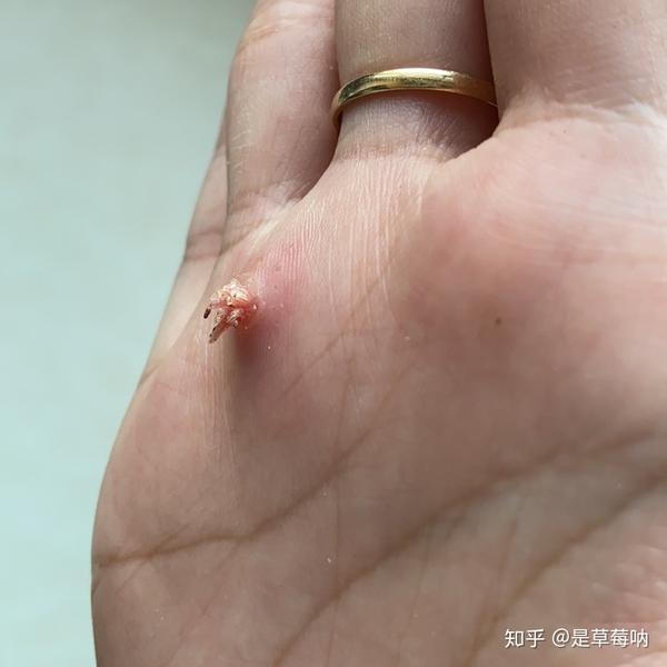 他们救活了瘊子chan酸梅汤治瘊子贴士