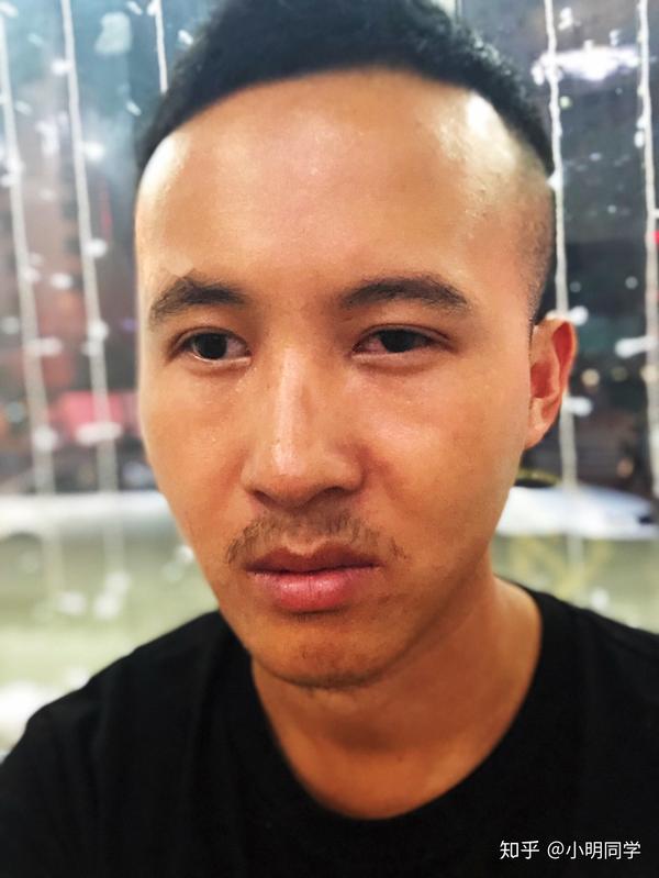 单眼失明是种怎样的体验?