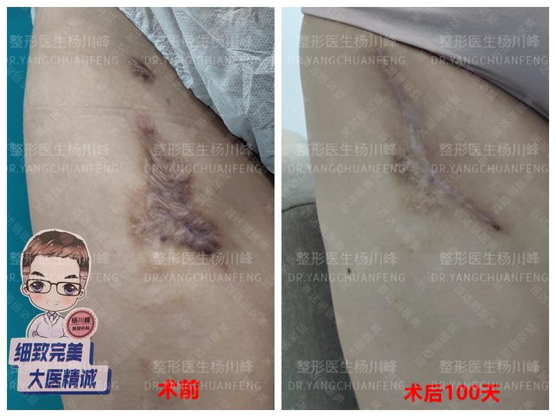 大腿吸脂术后严重的疤痕增生修复