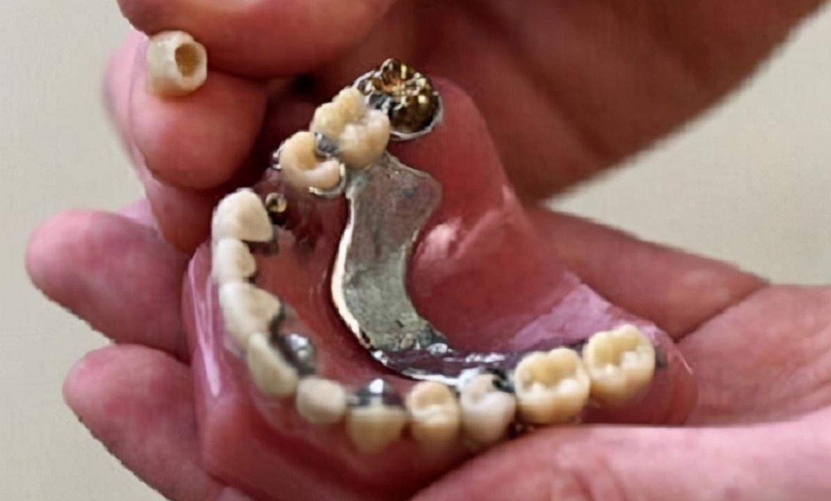 老年人为省钱镶了便宜假牙,导致多年口腔溃疡反复不愈