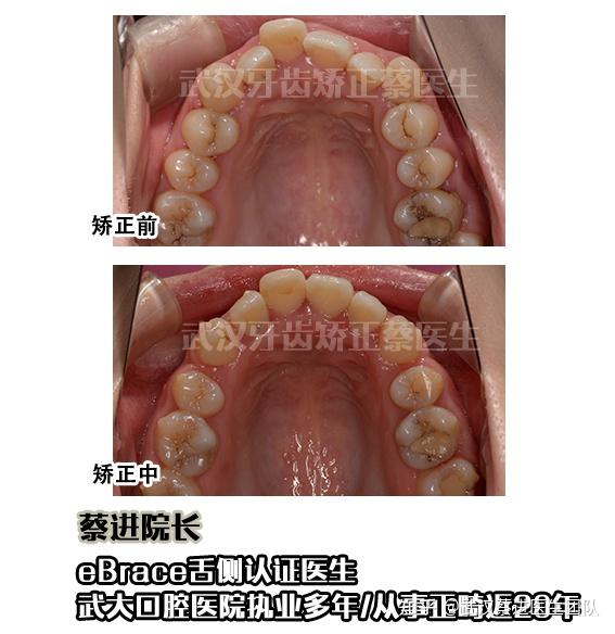 武汉牙齿矫正隐适美开颌病例正畸审美的重要性