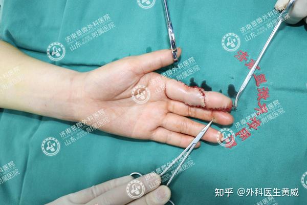食指缺损还能恢复如初吗3d全形手指再造术成功修复手指