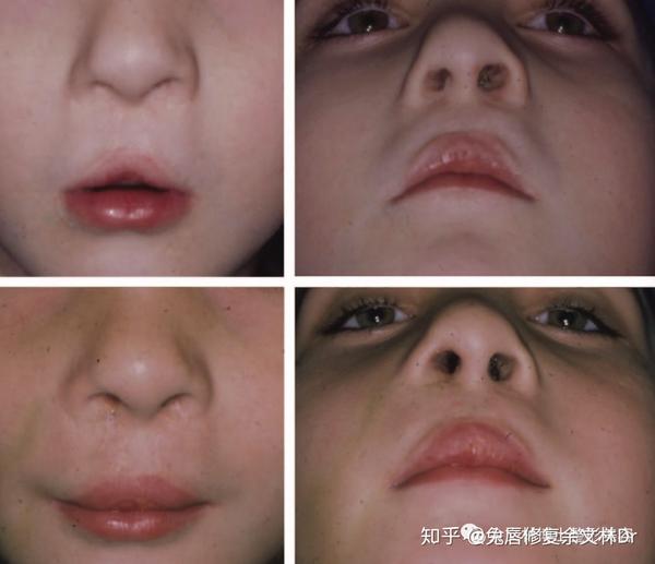 唇裂鼻子塌陷怎么修复:不对称唇裂鼻畸形案例