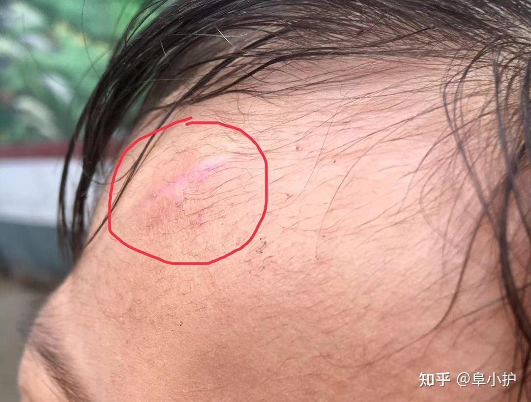 疤克什么时候用好伤口结痂时还是结痂掉落后疤克什么时候用好伤口结痂