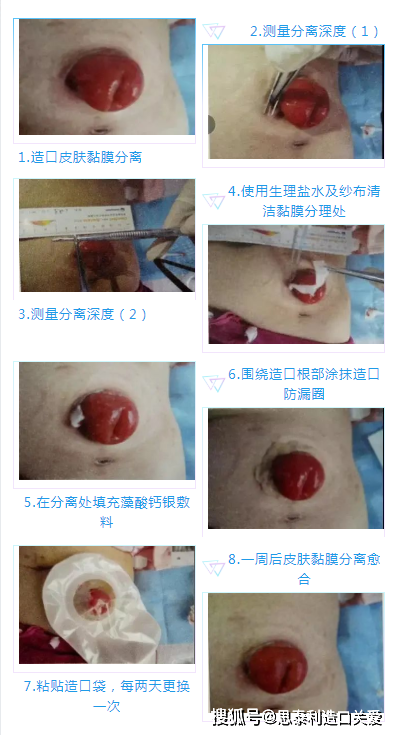 造口并发症造口皮肤黏膜分离