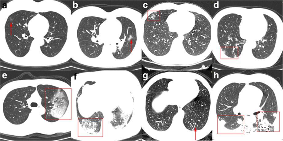 eur radiol:新型冠状病毒肺炎胸部ct影像学特征