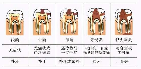 千里之堤毁于蚁穴,一颗"虫牙"这样悄悄伤害你