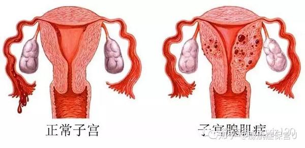 子宫腺肌症现在是世界的一大难题,是妇科疾病中最让女性烦恼的疾病
