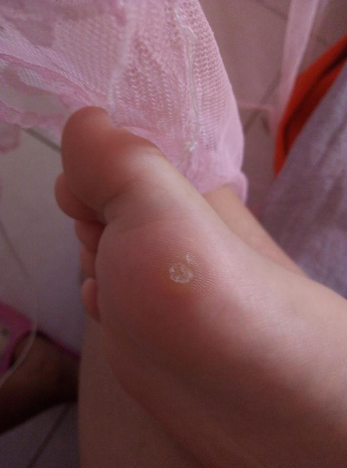跖疣的根有多深?