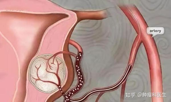 【肿瘤科普】子宫动脉栓塞术治疗子宫肌瘤