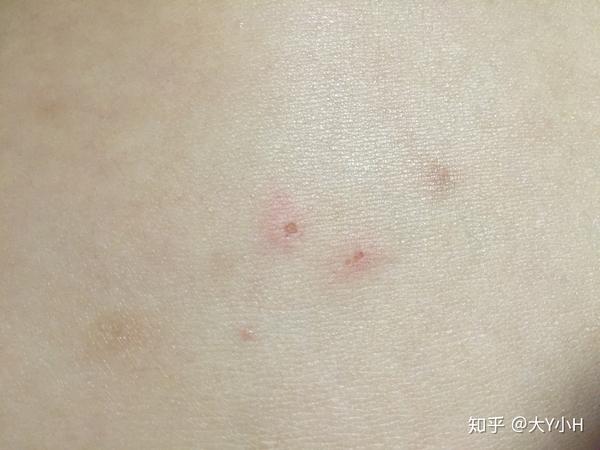 丘疹性荨麻疹(虫咬皮炎)持续恢复中,分享1个月抗疹经历