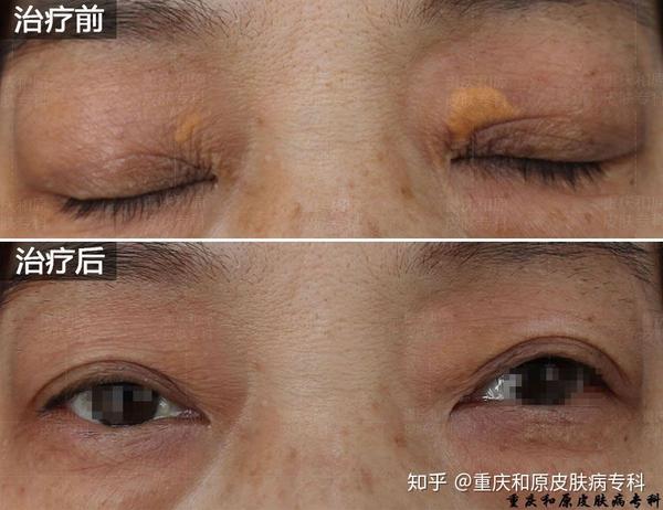 睑黄瘤为什么多发于中年?
