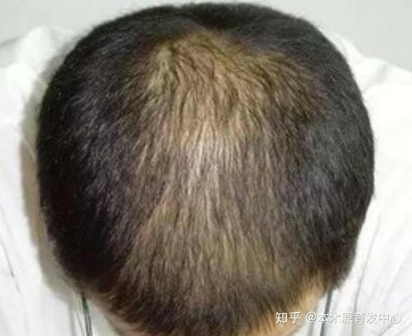 头顶头发稀少是受到什么原因影响?又该如何解决呢?