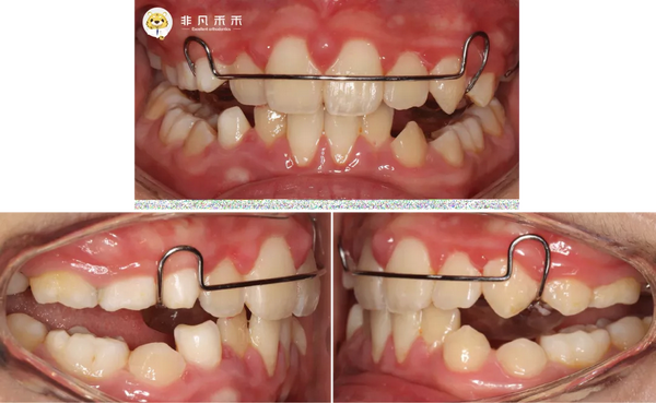 促进下颌发育 规整牙弓形态,引导牙齿正确萌出 ∨ 矫治结束曲面断层片