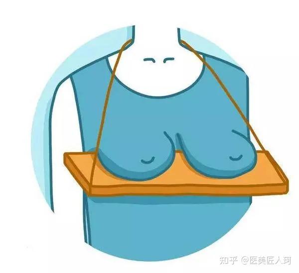 重度下垂:通过上提固定术,进行乳头乳晕上提,多余皮肤的去除以及乳房