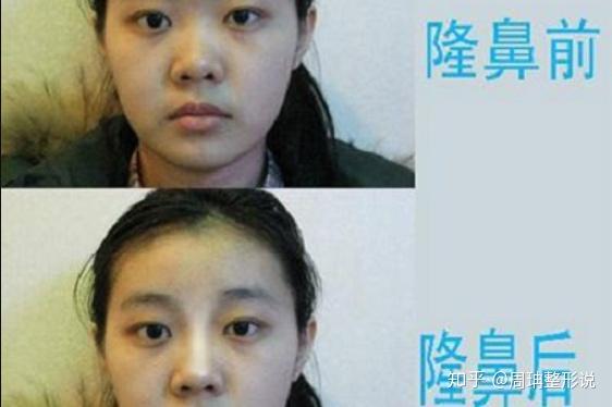 在做鼻翼缩小手术之前,护士会给妹子们剃去鼻毛以及清洁鼻子