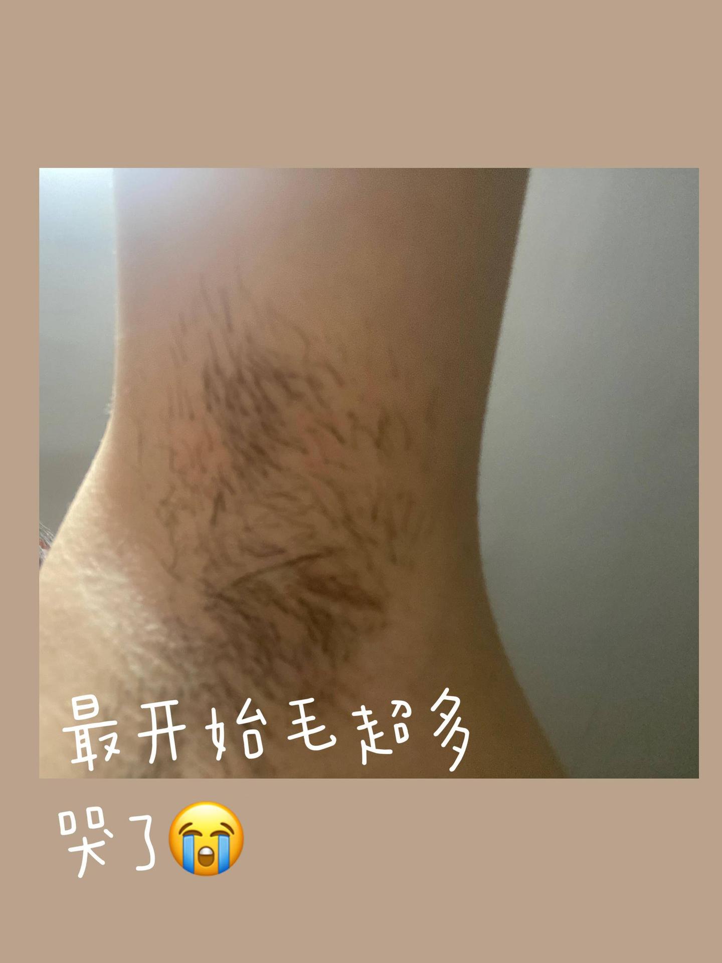 你们有那种一个毛孔长三根毛的经历么?我本人