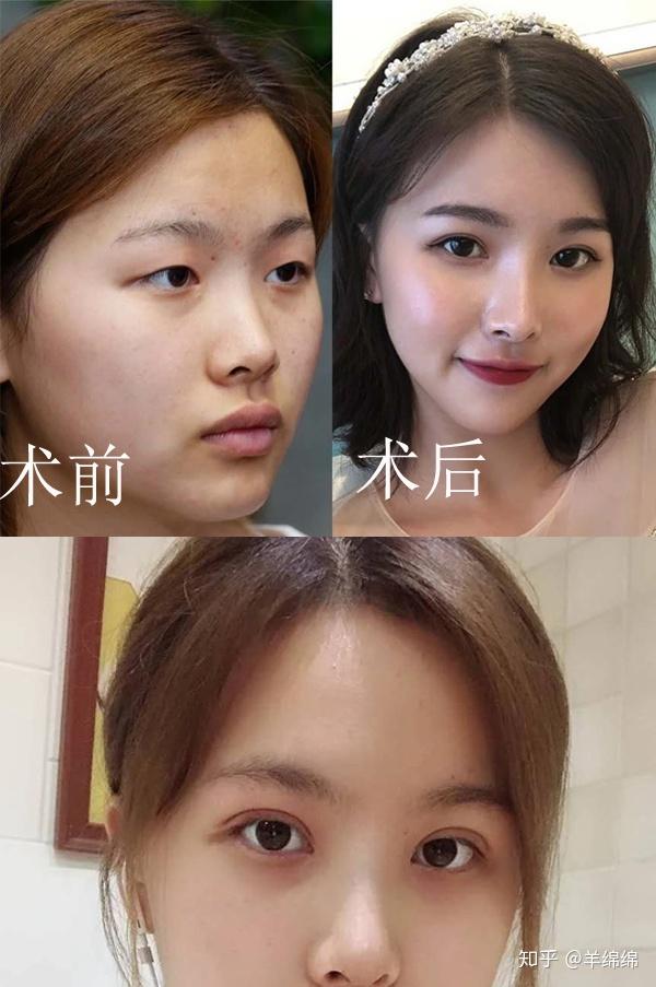 做双眼皮的时候开不开眼角