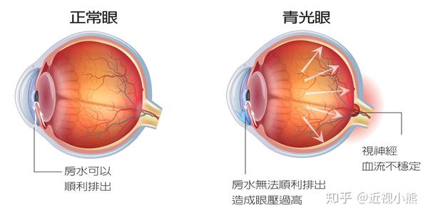 眼压过高导致青光眼?这些和高度近视也有关.