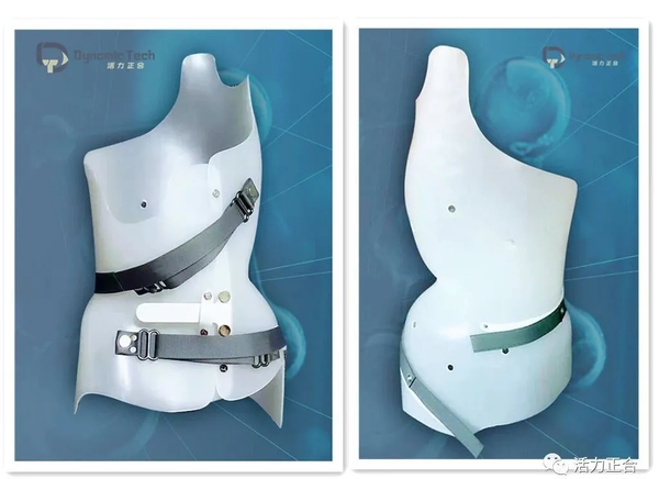 脊柱侧弯3d矫形器设计与制造