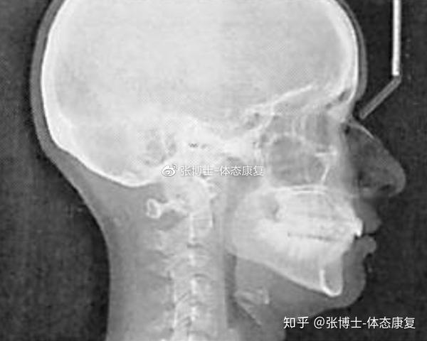 【译文分享】颞下颌关节与腘绳肌之间的联系,骨盆如何