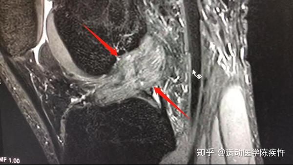 膝关节运动中反复扭伤当心它的看门狗韧带前交叉韧带损伤