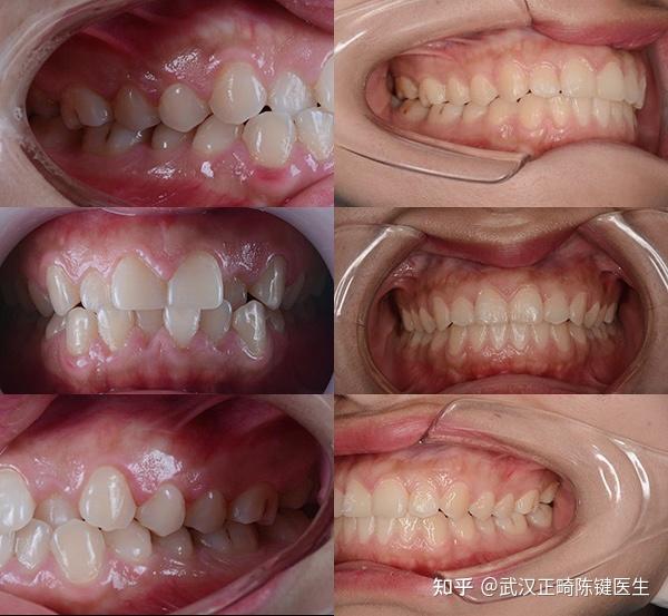 牙列排列整齐,前牙咬合恢复成正常覆合覆盖,解除牙列拥挤,上下颌中线