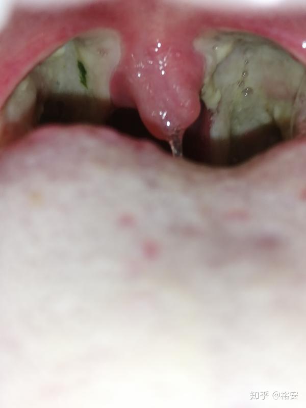 扁桃体摘除手术记录
