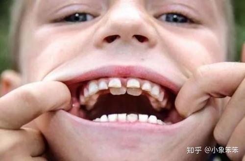 小孩子的双排牙该不该拔掉