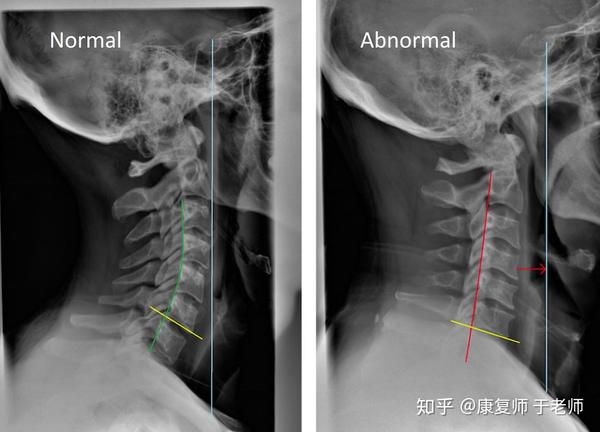 颈椎生理曲度正常与变直