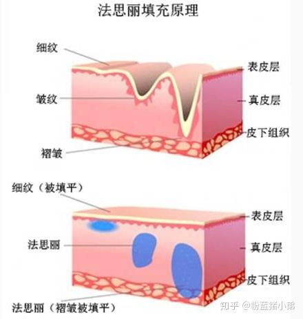 水光针的有效性------玻尿酸的工作原理 吸水,补水 锁水