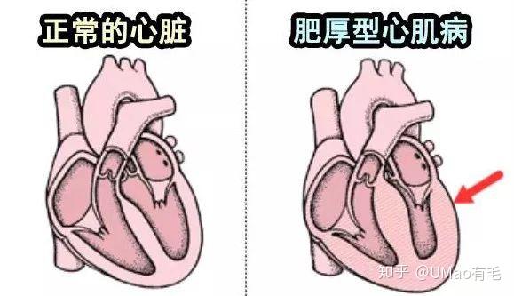 正常心脏和患病心脏的对比