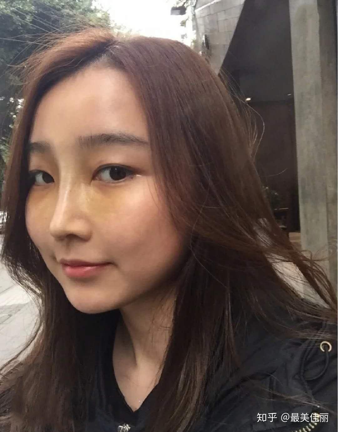 即使没钱也要贷款做的隆鼻手术