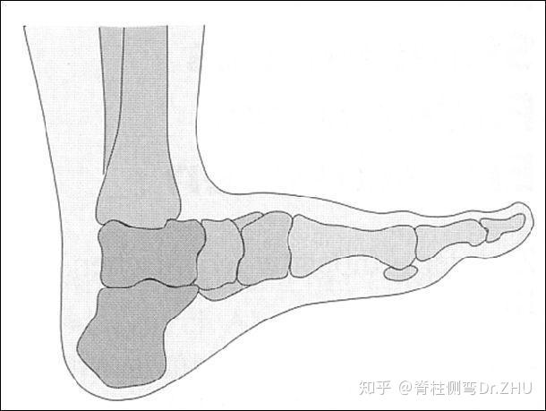 由于足的肌腱和韧带(后侧和深部的)发育出现故障,未能与足部其他的