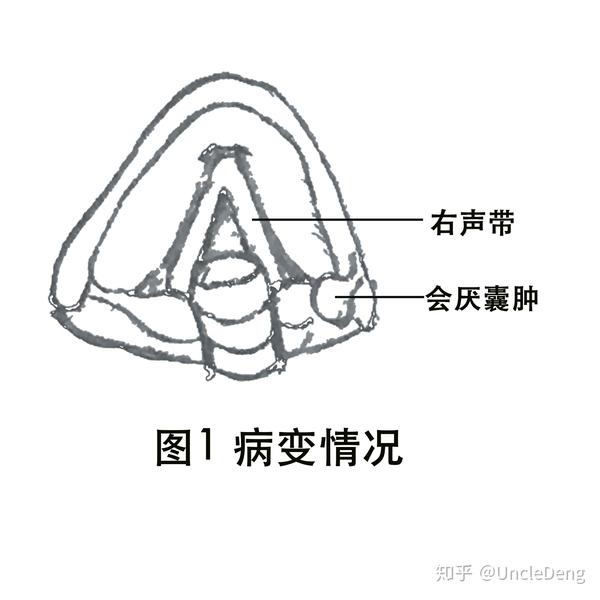 会厌囊肿切除手术1例