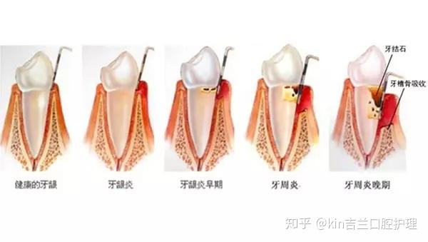 如何区别牙龈炎和牙周炎?