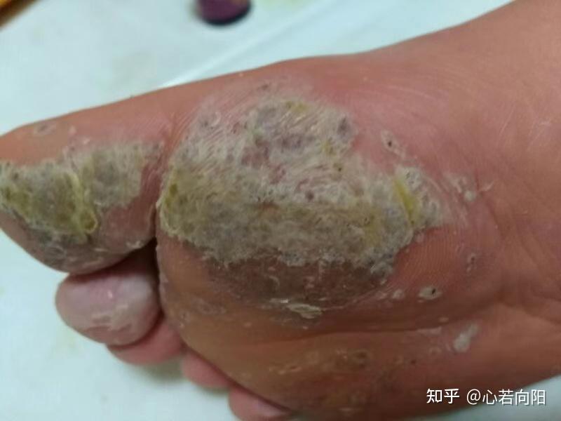 在经历了漫长的五个月的泡脚和涂抹之后,脚底的跖疣终于全部脱落干净