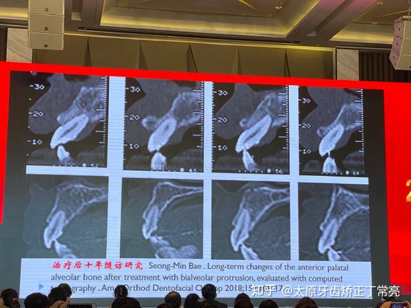 太原隐形牙齿矫正丁常亮请正确认识骨开窗骨开裂