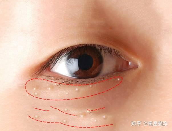 眼部长出脂肪粒的原因有哪些?