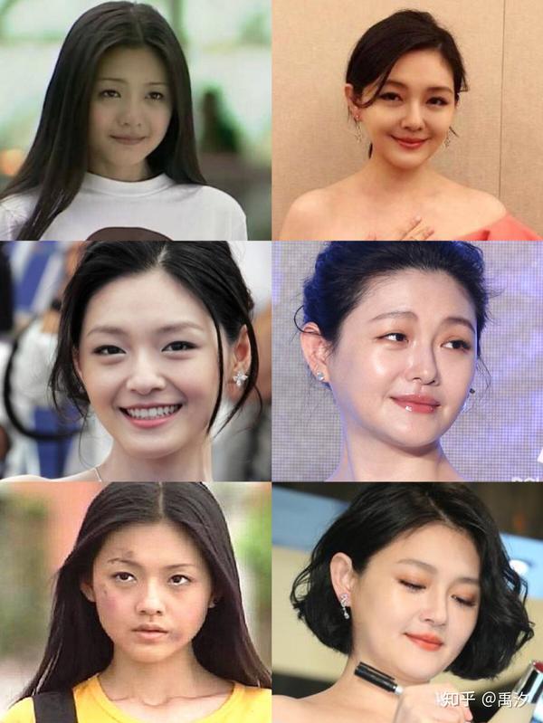 圆脸,现在脸型基本没变,最多是咬肌稍瘦了些,脸型特征依然保留,在鼻子
