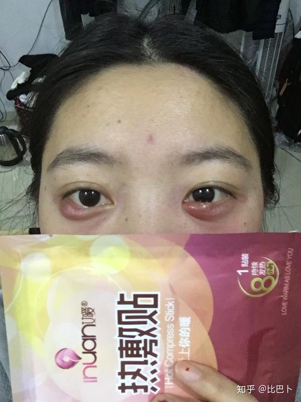 过程中一直滴眼药水,热敷很管用,把硬包敷软,脓就容易排出来了,像